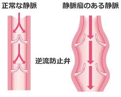 足のムクミ　静脈弁の状態